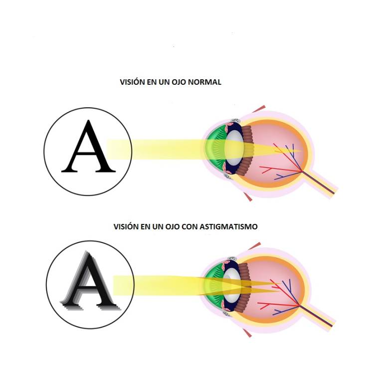 Lee más sobre el artículo Astigmatismo que es: Entiende sus causas y síntomas