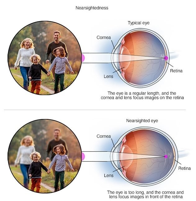 Lee más sobre el artículo Miopía que es: Causas, síntomas y tratamientos que debes conocer
