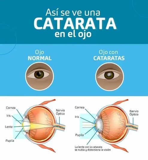 Lee más sobre el artículo ¿Qué son las cataratas y cómo afectan tu visión?