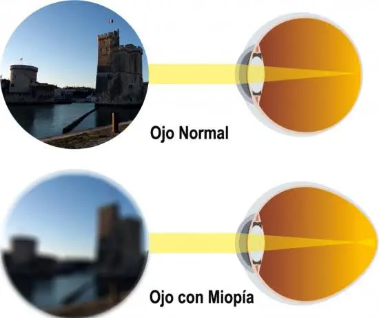 COMO-SE-VE-CON-MIOPIA