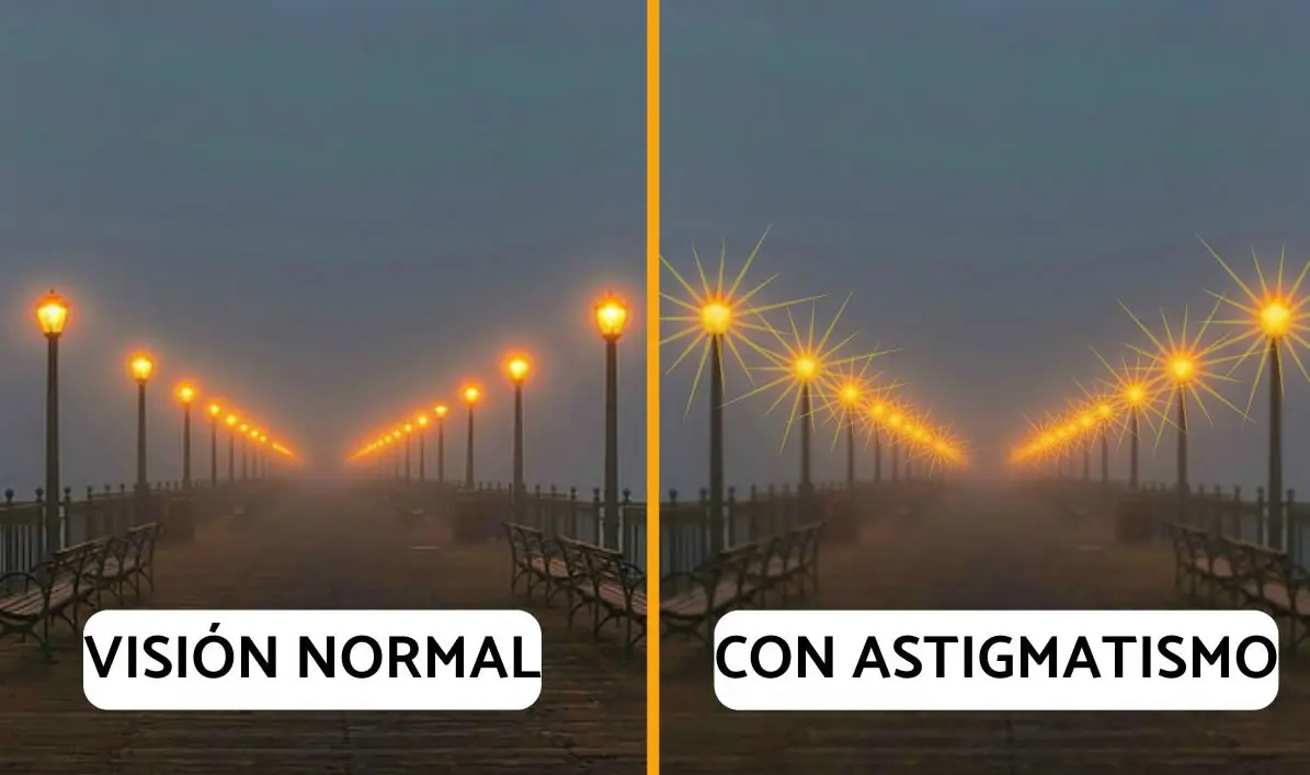 astigmatismo