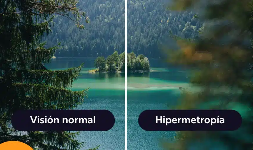 hipermetropia